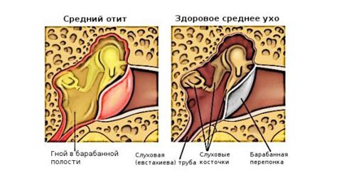 Альтернативные методы слушания звуков при воспалении среднего уха