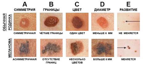 Альтернативные подходы: безопасные методы устранения пигментных невусов