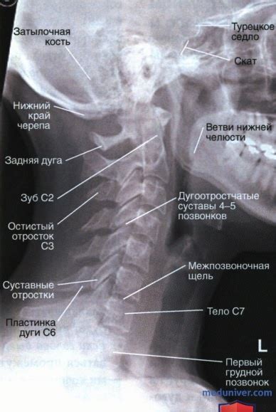 Анатомическое расположение верхних шейных позвонков C5 и C6