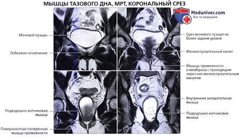 Анатомическое расположение подвижного нерва малого таза 