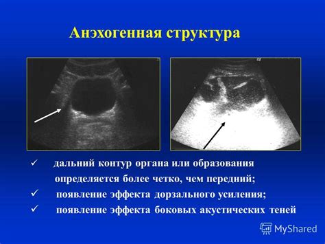 Анэхогенное образование: причины и признаки