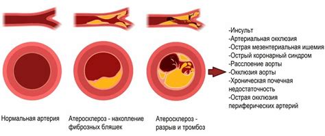 Атеросклероз как главная причина образования сгустка в коронарных артериях