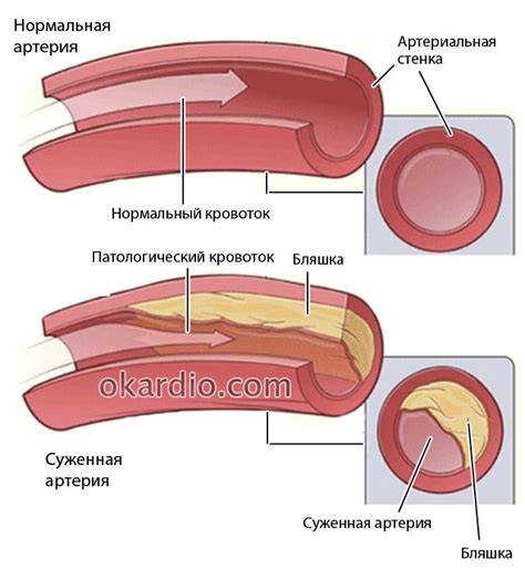 Блокировка и ишемия коронарных артерий