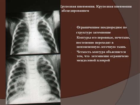 Важное мнение экспертов о потреблении жидкости перед рентгеном органов дыхания