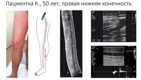 Важность дуплексного сканирования вен нижних конечностей