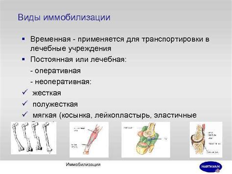 Виды гипсовой иммобилизации