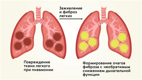 Вклад компьютерных технологий в идентификацию воспаления легких