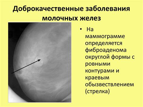 Влияние гипоплазии молочных желез на кормление ребенка