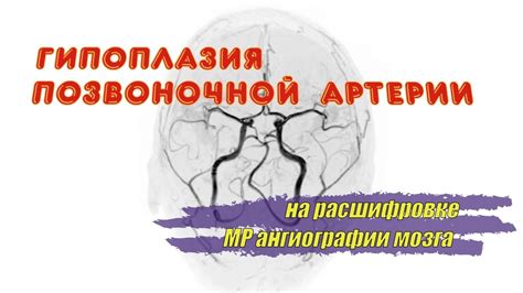 Влияние гипоплазии поперечного синуса справа на жизнь