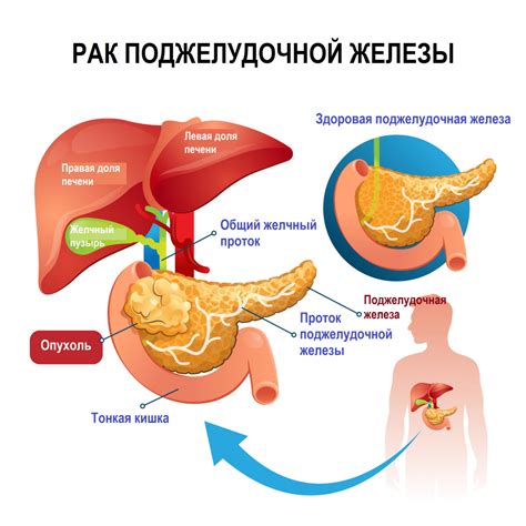 Влияние диеты на гепатомегалию поджелудочной железы