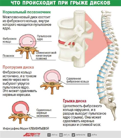 Влияние лечения грыжи позвоночника на сопутствующие симптомы и изменения температуры