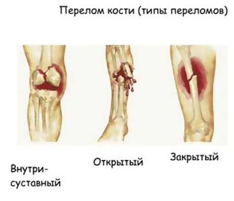 Влияние повреждений и травм на радиальную кость