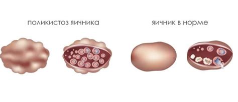 Влияние поликистоза яичников на процесс беременности