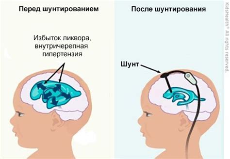 Внутричерепная гипертензия: суть и симптомы