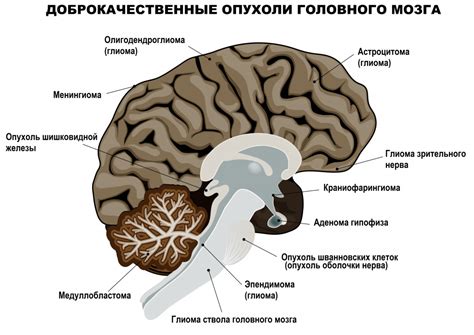 Возможность появления опухоли головного мозга при наличии приступов сильной головной боли