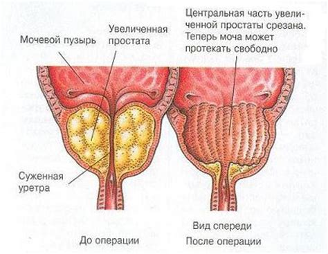 Возможные причины гипоэхогенного участка в предстательной железе