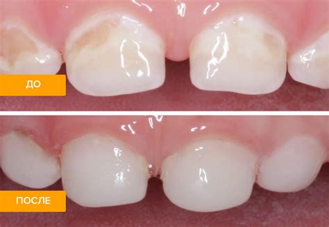 Врачебные методы лечения гипоплазии зубной эмали
