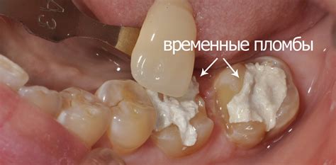 Временная пломба как потенциальный источник риска инфекции