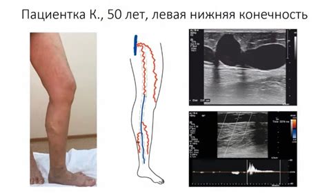 Выбор надежных центров для дуплексного исследования вен нижних конечностей