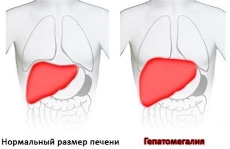 Гепатомегалия: причины, симптомы и лечение - все, что нужно знать