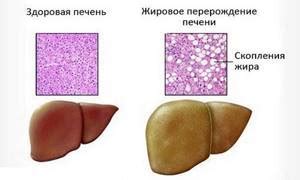 Гепатомегалия жирового гепатоза