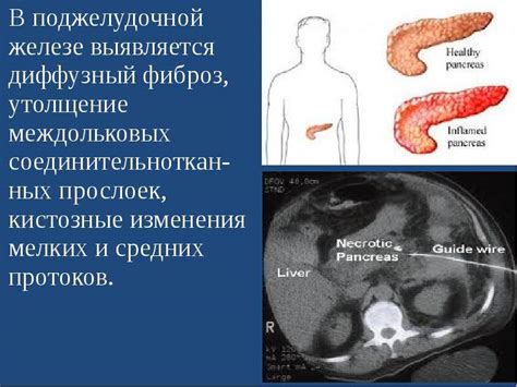 Гепатомегалия поджелудочной железы: что это такое?