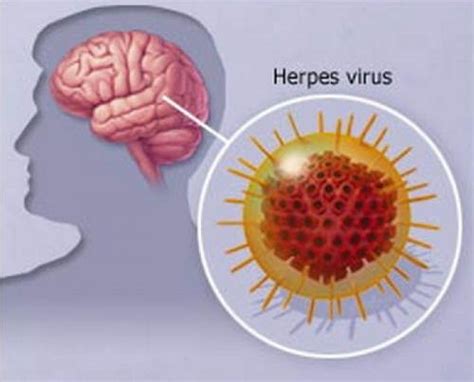 Герпесный энцефалит и его возникновение