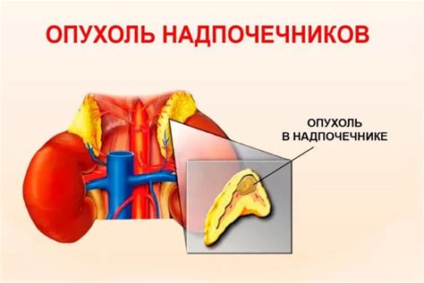 Гиподенсивное образование надпочечника