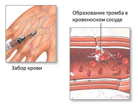 Гипокоагуляция крови: что это такое и какая ее роль в организме?