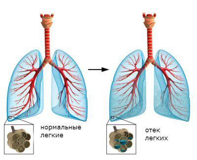 Гипоксемия: роль, симптомы и последствия