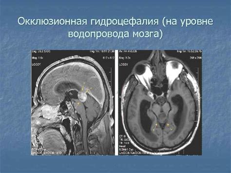 Гипоплазия головного мозга у взрослых: