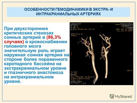 Гипоплазия интракраниального сегмента левой позвоночной артерии