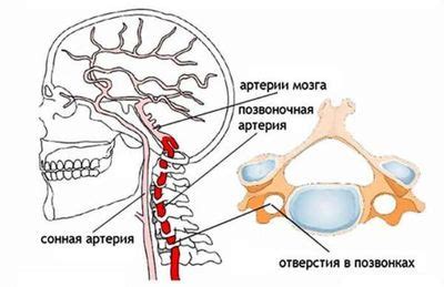 Гипоплазия интракраниального сегмента правой позвоночной артерии