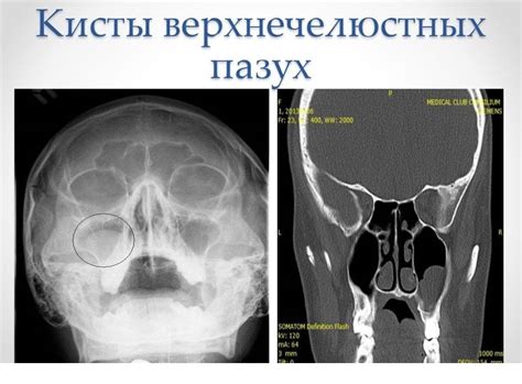 Гипоплазия правой верхнечелюстной пазухи: основные причины, симптомы и методы лечения