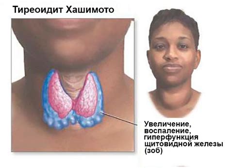 Гипотиреоз: причины и факторы риска