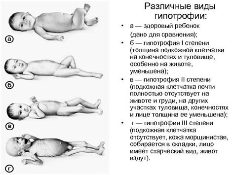 Гипотрофия 1 степени у взрослого