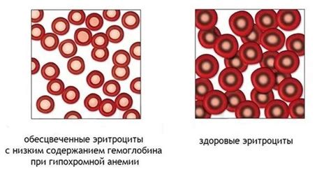 Гипохромия слабо выражена: причины и следствия