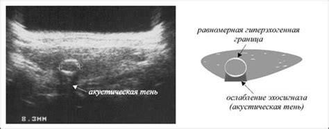 Гипоэхогенное образование: понятие и значение