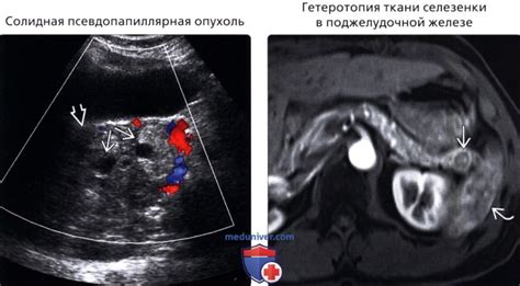 Гипоэхогенное образование: симптомы и признаки