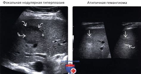 Гипоэхогенное образование в печени: что это такое?