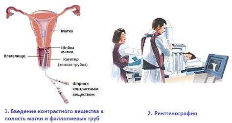 Гистеросальпингография: что это и какие преимущества