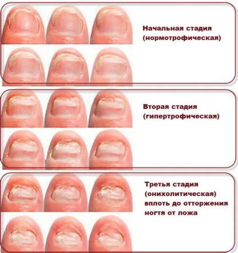 Грибок ногтей: основные причины и симптомы