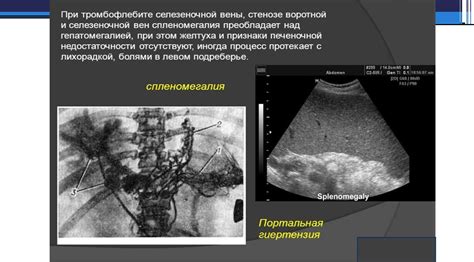 Диагностика гепатомегалии почек