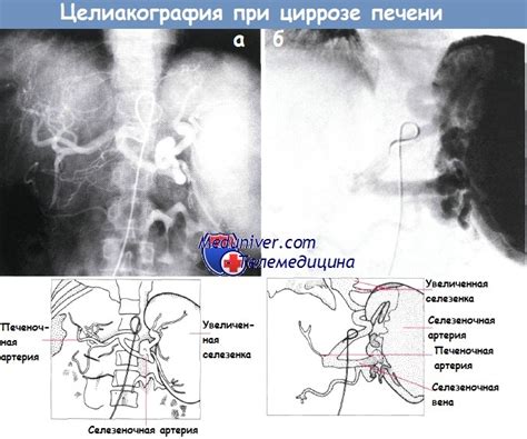 Диагностика гепаторенального синдрома при циррозе