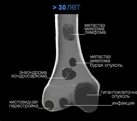 Диагностика гипоанэхогенного образования