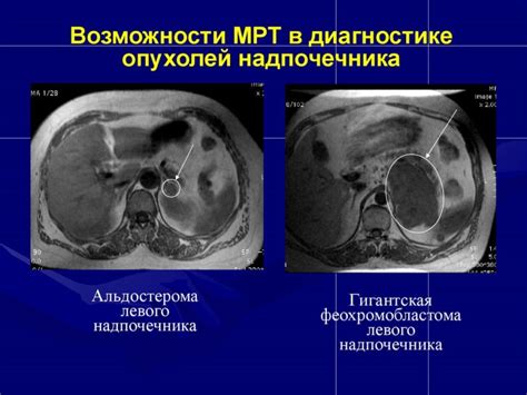 Диагностика гиподенсивного образования надпочечника