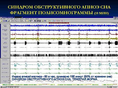 Диагностика гипопноэ