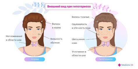 Диагностика гипотиреоза на фоне хаеша