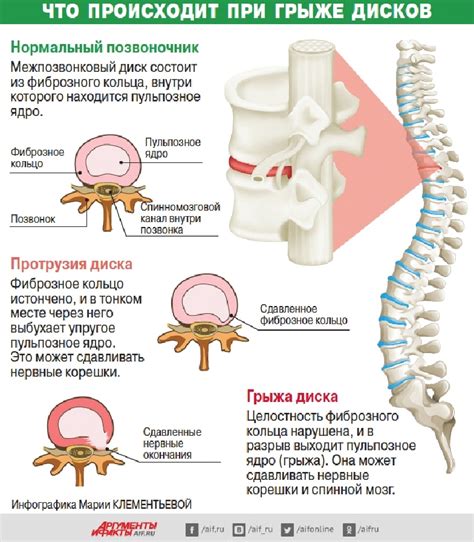 Диагностика грыж позвоночника