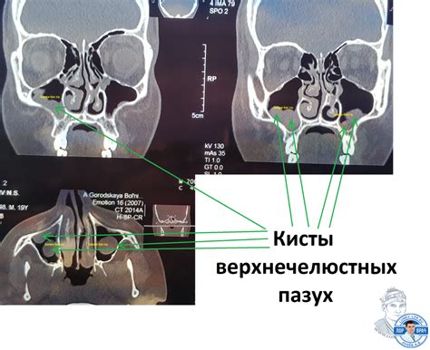 Диагностика изменений слизистой правой верхнечелюстной пазухи: обнаружение и определение причин